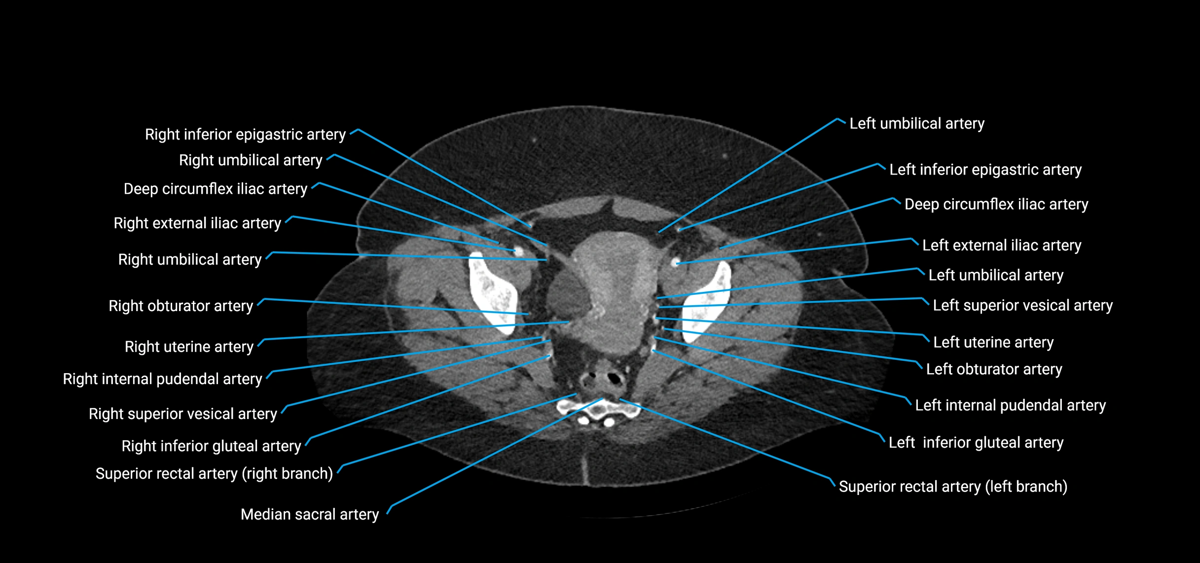 CTA abdomen axial cross sectional anatomy labelled image_223 (2).webp
